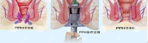 痔上黏膜环切吻合术手术过程