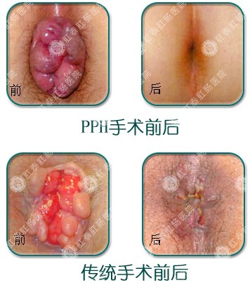 痔上黏膜环切吻合术手术与传统手术效果对比