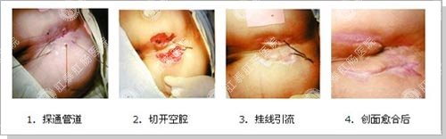主页 典型病例 肛门损伤 图解后马蹄形肛瘘手术过程  手术步骤: 1.