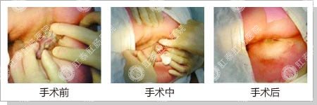 解析肛裂三联症的手术过程