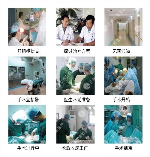 智能痔上黏膜环切吻合术技术过程图片