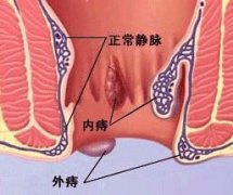 导致痔疮的原因