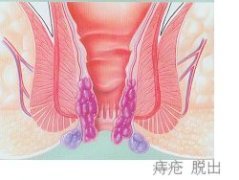 痔疮
