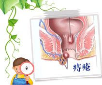 混合痔