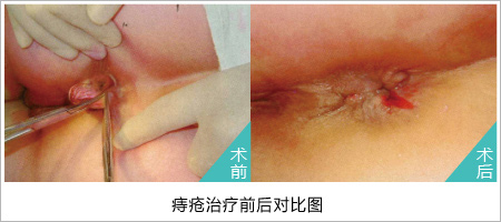 痔疮的较佳治疗方法