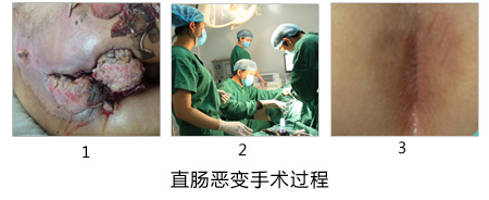 直肠息肉图片