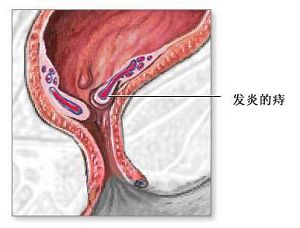 得了外痔会有哪一些症状 内痔的症状表现? 痔疮患者如何自我诊断