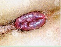 血栓性外痔疮的症状