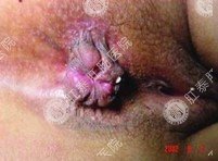 结缔组织外痔疮的症状