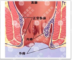 主页 痔疮 混合痔 女性混合痔会有哪些危害