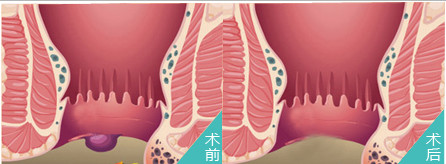主页 痔疮 痔疮 割痣疮大概几天才好  割痣疮大概几天才好 ?