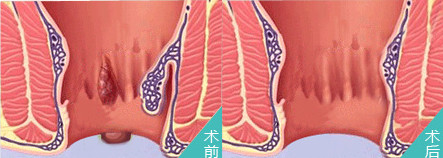 青岛外痔疮的较佳治疗方法